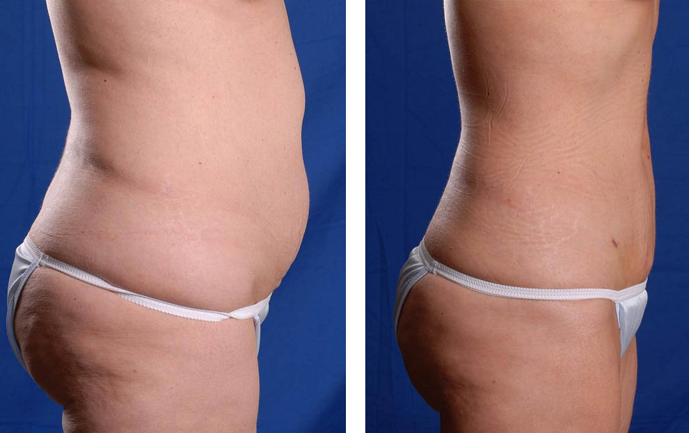 Фото криолиполиза: до после