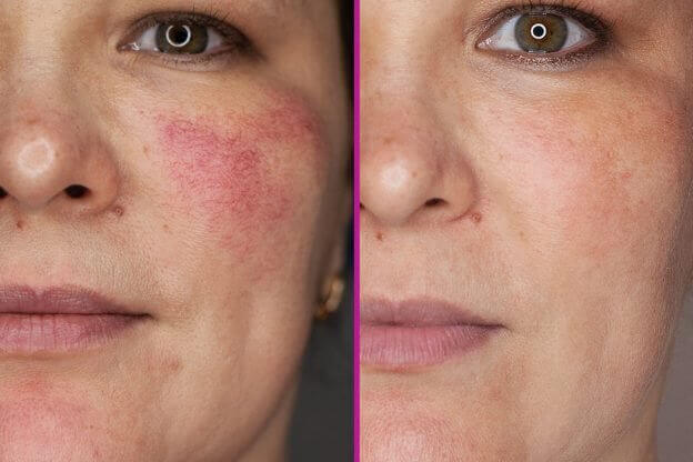 Фото до после удаления купероза фотоомоложением