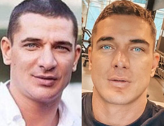 Курбан Омаров ринопластика