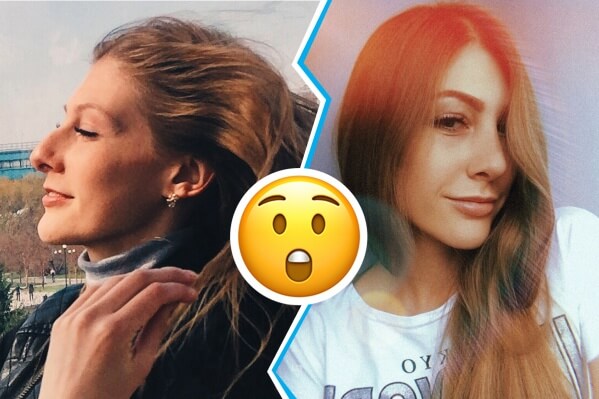 Фото до&nbsp;после ринопластики и&nbsp;септопластики