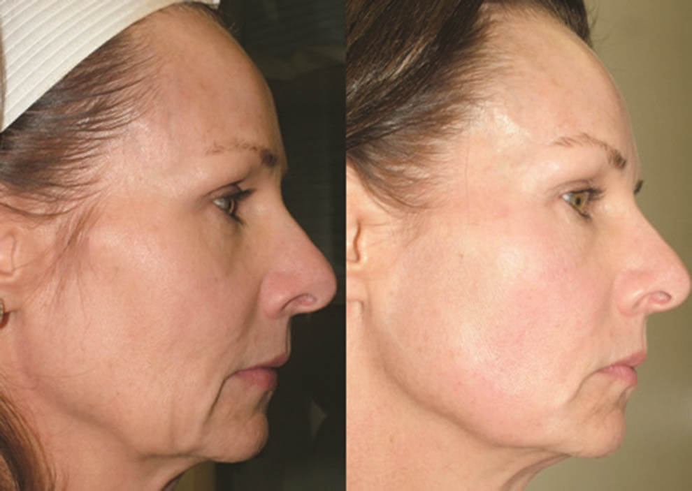 Фото после лифтинга Мендельсона