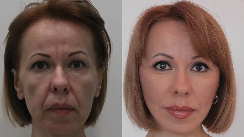 Фото до после лифтинга Мендельсона