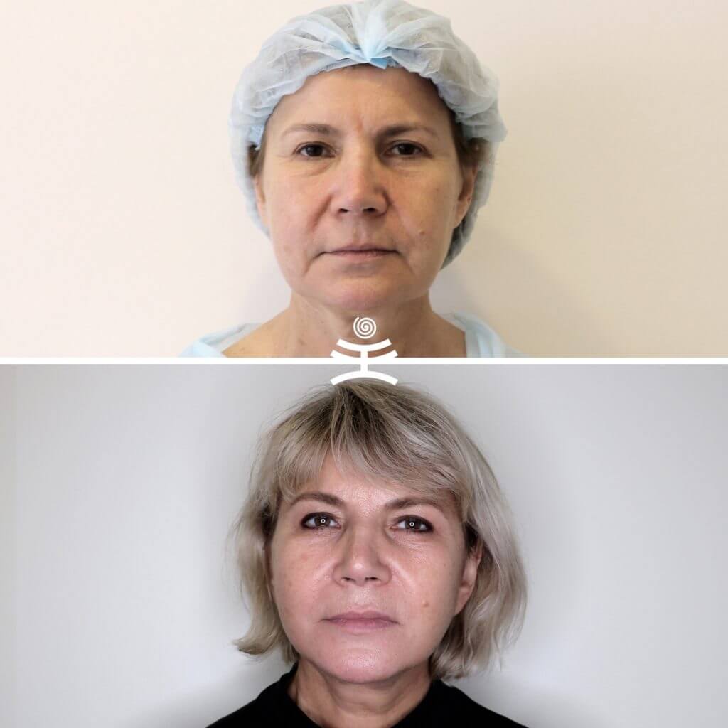 Фото до после лифтинга Мендельсона после 50