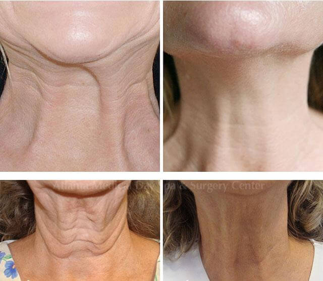 Лифтинг Нефертити фото до после подтяжки шеи