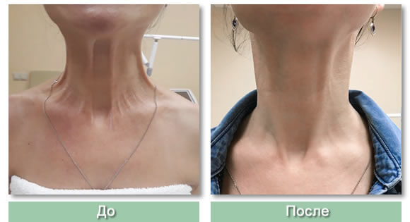 Лифтинг шеи фото до после метода Нефертити