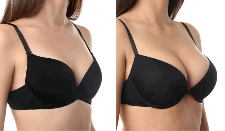 Фото до после липофилинга груди