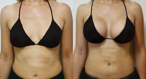 Фото до после маммопластики: такого результата липофилинг не даст