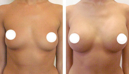 Фото до после липофилинга груди – максимальный результат