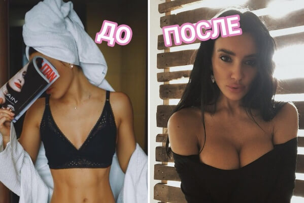 Фото до после увеличения груди липофилингом