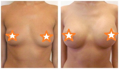 Фото до после липофилинга груди