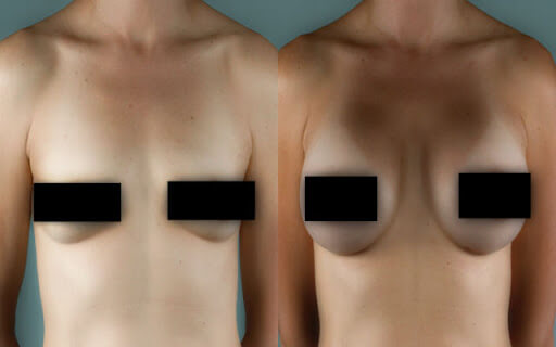Результат липофилинга груди – фото до после