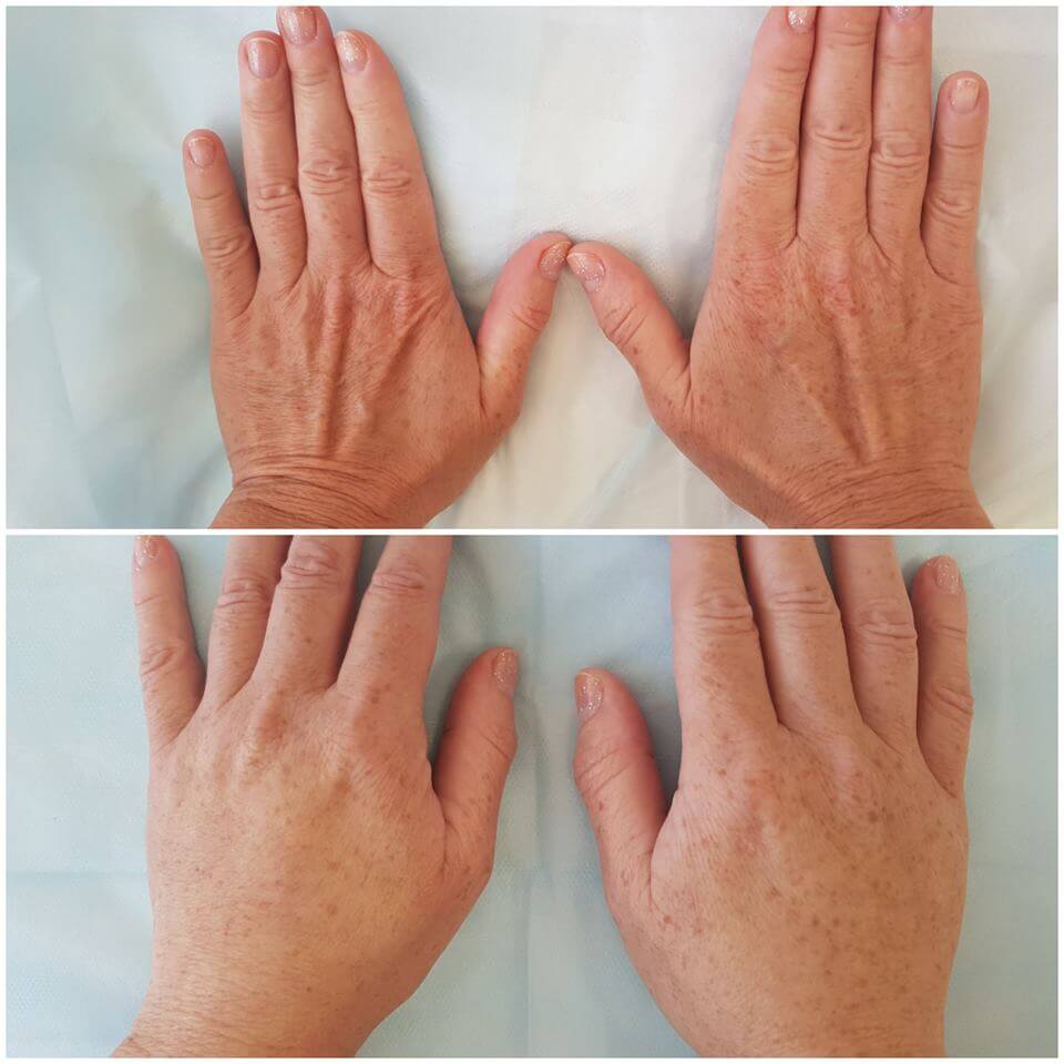 Фото до&nbsp;и&nbsp;после липофилинга рук