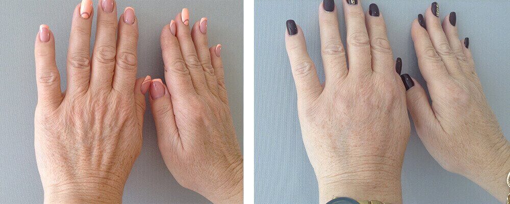Липофилинг рук фото до&nbsp;после