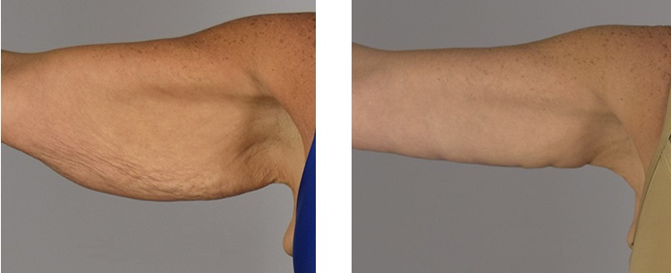 Фото до после подтяжки рук