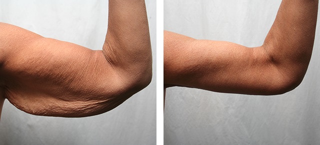 Подтяжка рук фото до после