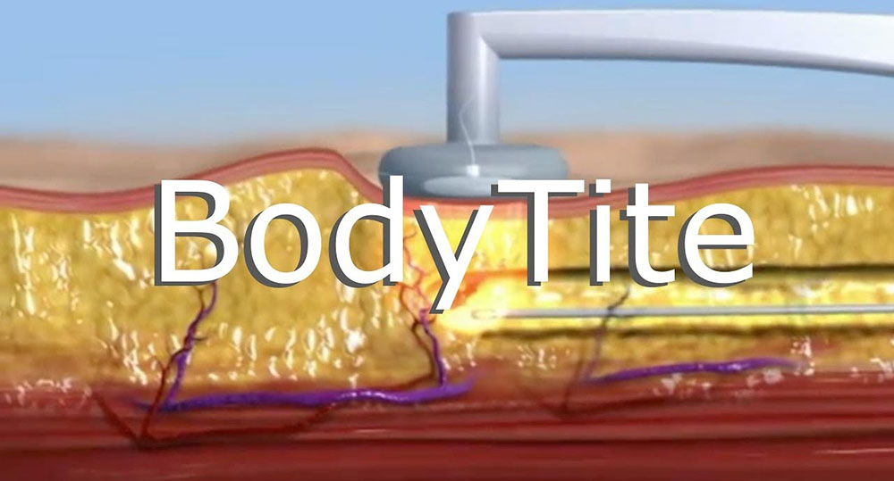 Липосакция