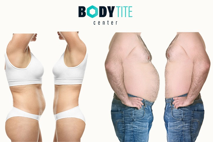 Липосакция Body Tite