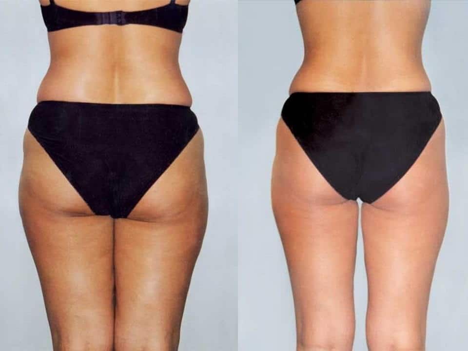 Фото до&nbsp;после липосакции BodyTite