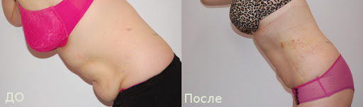 Фото до&nbsp;после липосакции живота (3 недели)
