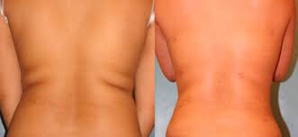 Липосакция спины фото до&nbsp;после