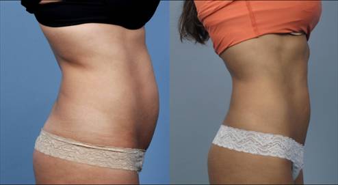 Фото до&nbsp;после липосакции Body Tite