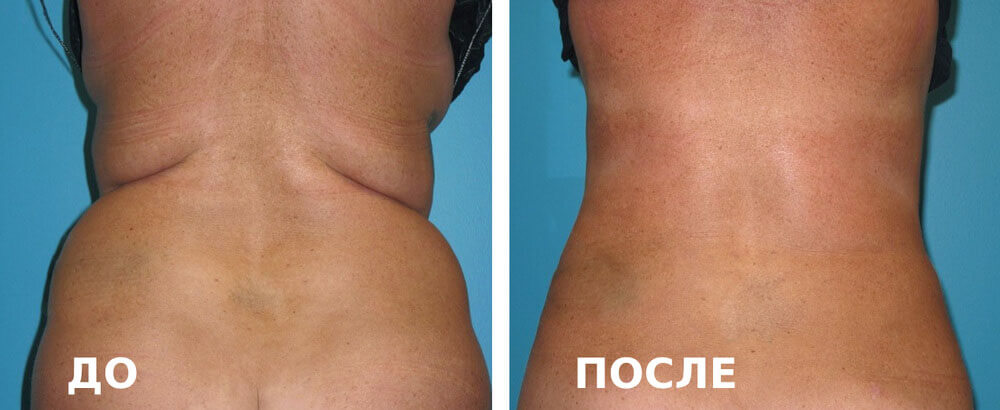 Фотографии до&nbsp;и&nbsp;после липосакции спины