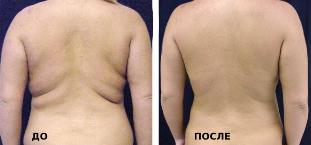 Фотографии до&nbsp;после липосакции спины