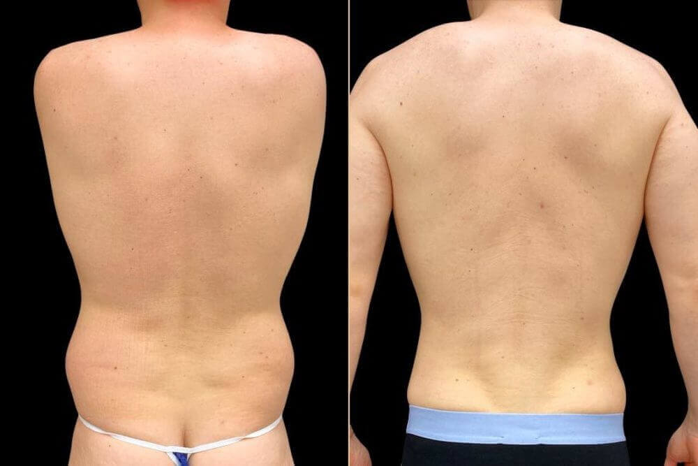 Липосакция спины фото до&nbsp;после