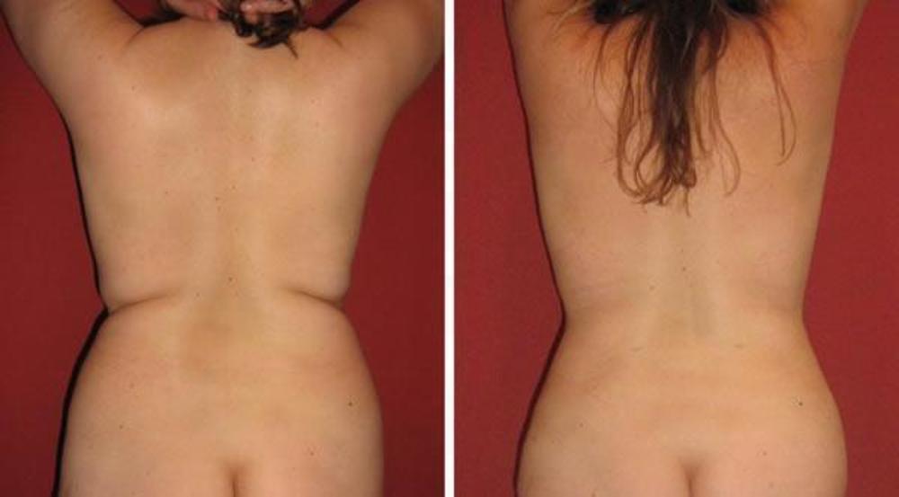 Фото до&nbsp;и&nbsp;после липосакции спины