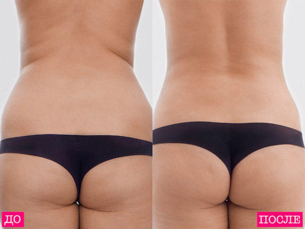 Фото до&nbsp;после липосакции спины