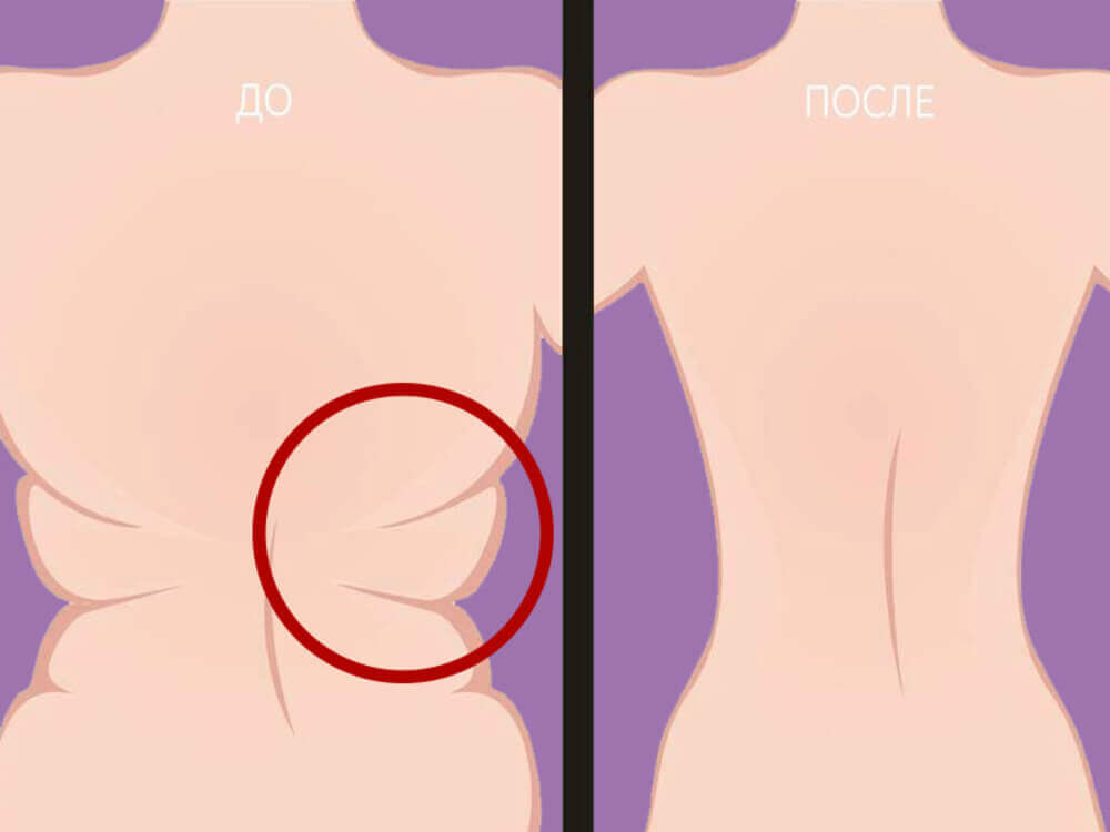 Липосакция спины схематическое отображение