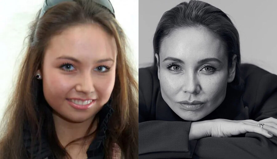 Ляйсан Утяшева пластика скул