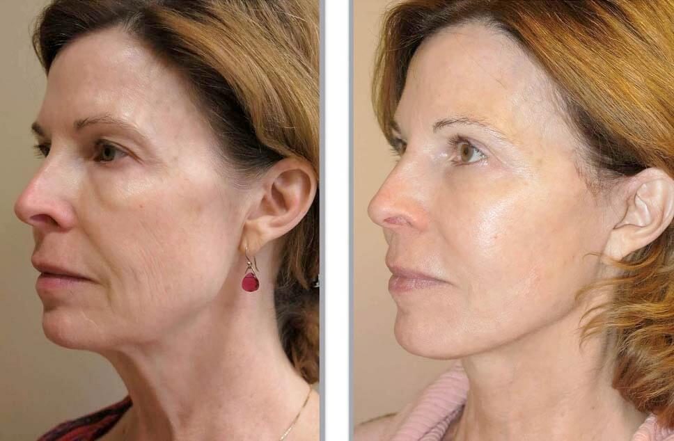 Фото до и после МАКС-лифтинга