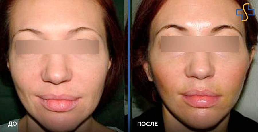 Фото до после МАКС-лифтинга