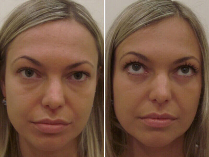 Коррекция малярных мешков до после