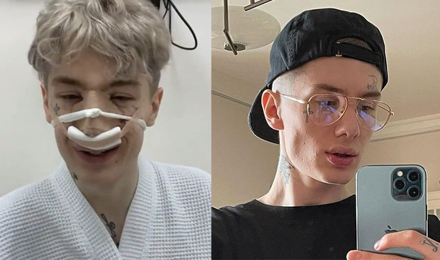 Олег Манекен ринопластика