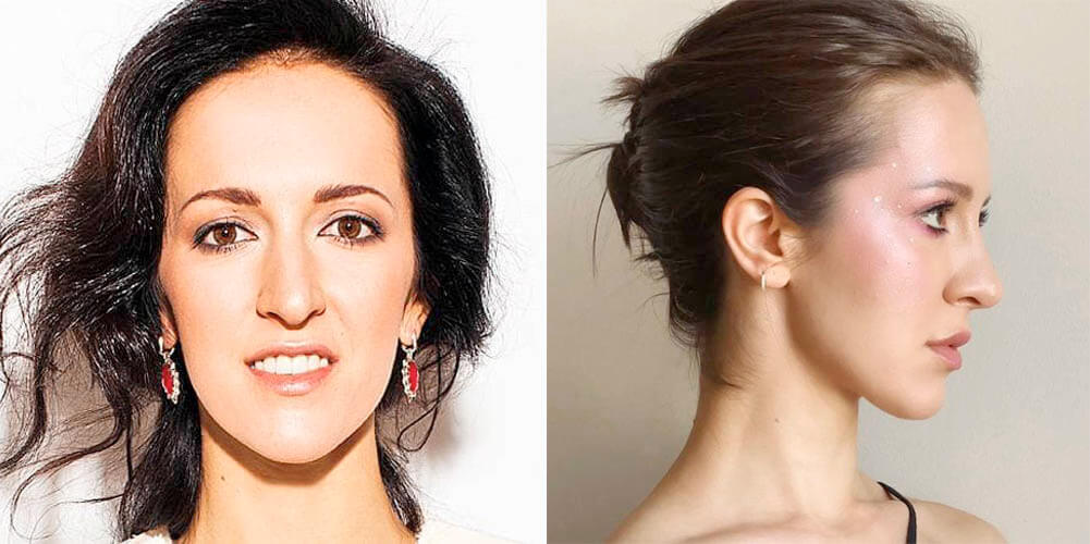 Матильда Шнурова до пластики