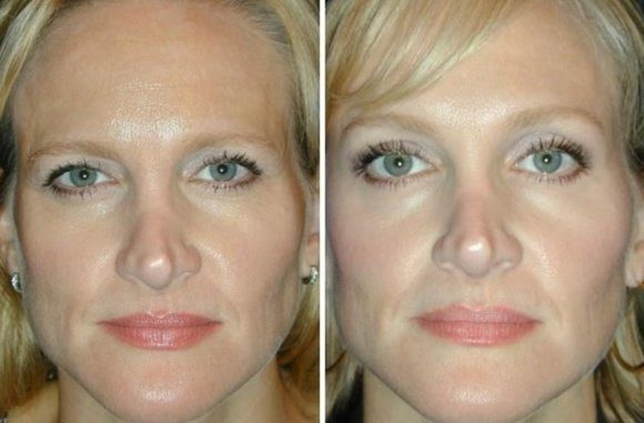 Фото до после мезонитей