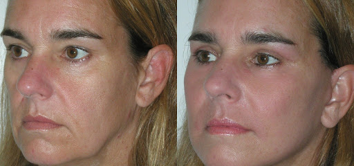 Фото до после установки мезонитей