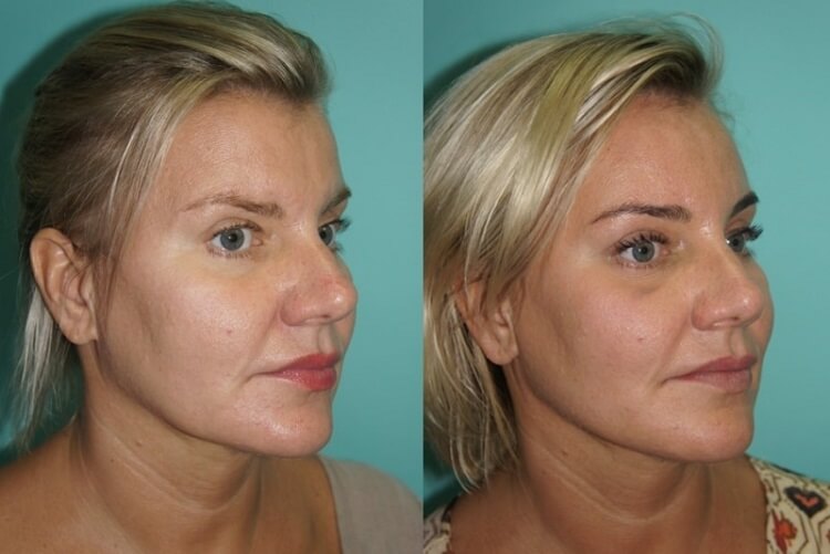 Применение мезонитей фото до после