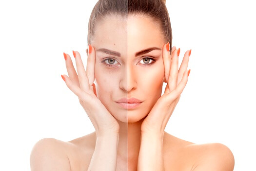 Фотоомоложение &ndash; результат на&nbsp;картинке