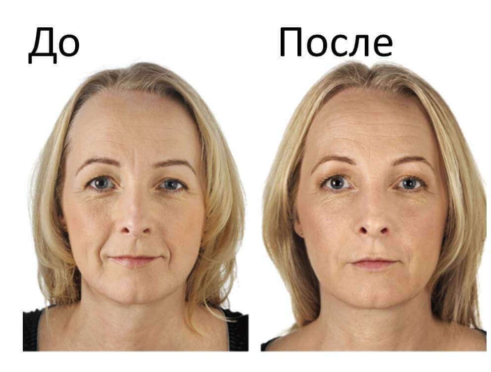Фото до&nbsp;после фотоомоложения (курс из&nbsp;6 процедур)