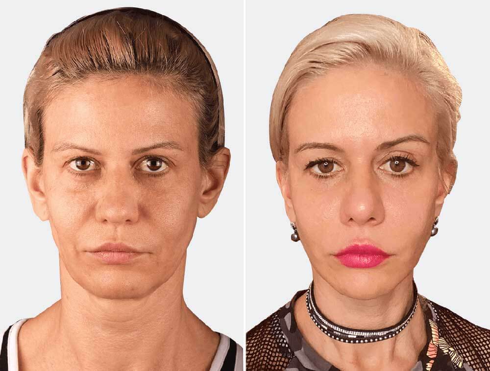 Фото до&nbsp;и&nbsp;после подтяжки лица нитями