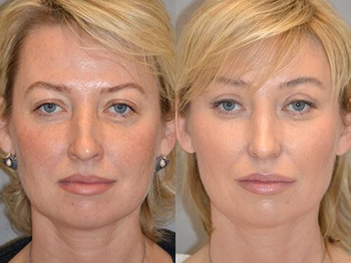 Фото до&nbsp;после подтяжки лица нитями