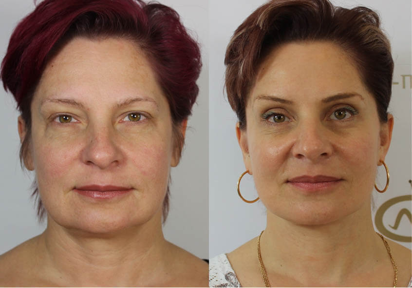 Фото до&nbsp;после мини подтяжки лица