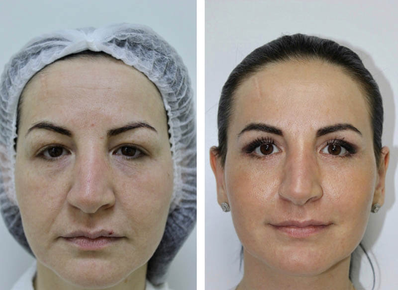 Мини подтяжка лица фото до&nbsp;после