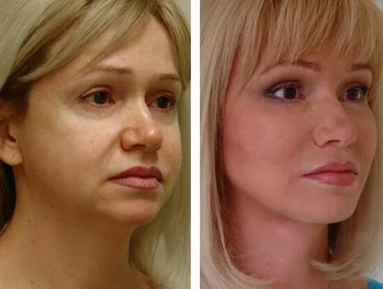 Мини подтяжка лица нитями фото до&nbsp;после