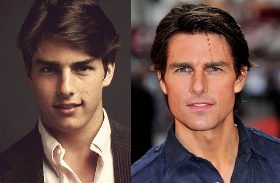 мужская ринопластика: Том Круз