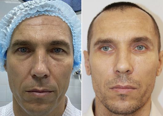 Фото до&nbsp;и&nbsp;после пластики век у&nbsp;мужчин