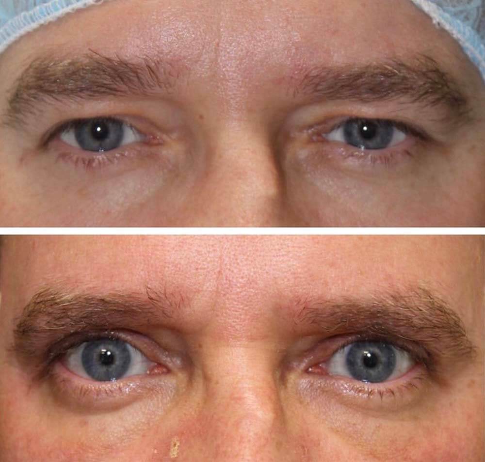 Мужская блефаропластика фото до&nbsp;после